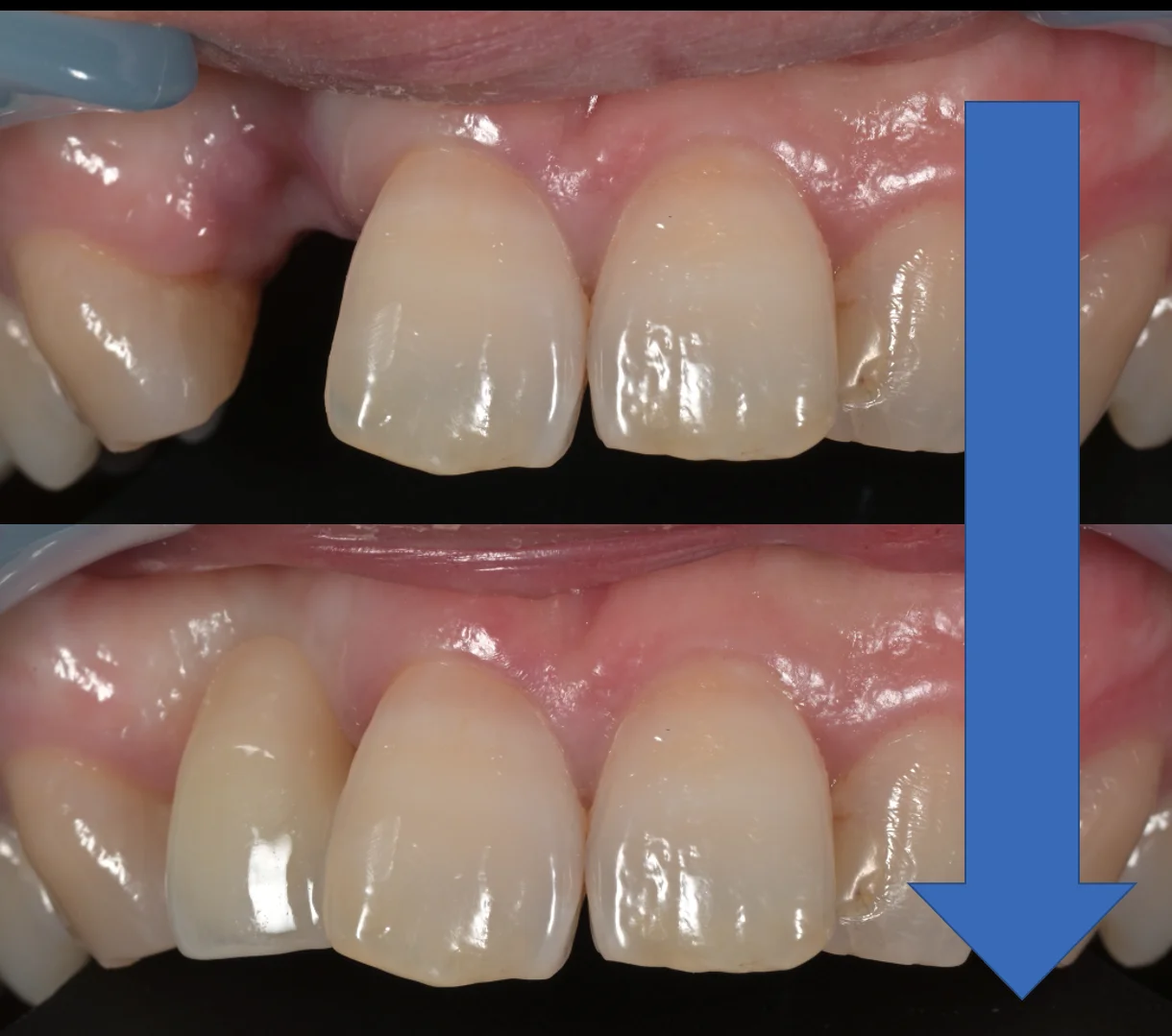 審美治療+歯質保存:延長セラミックブリッジ|坂寄歯科医院(取手市藤代) - 画像6