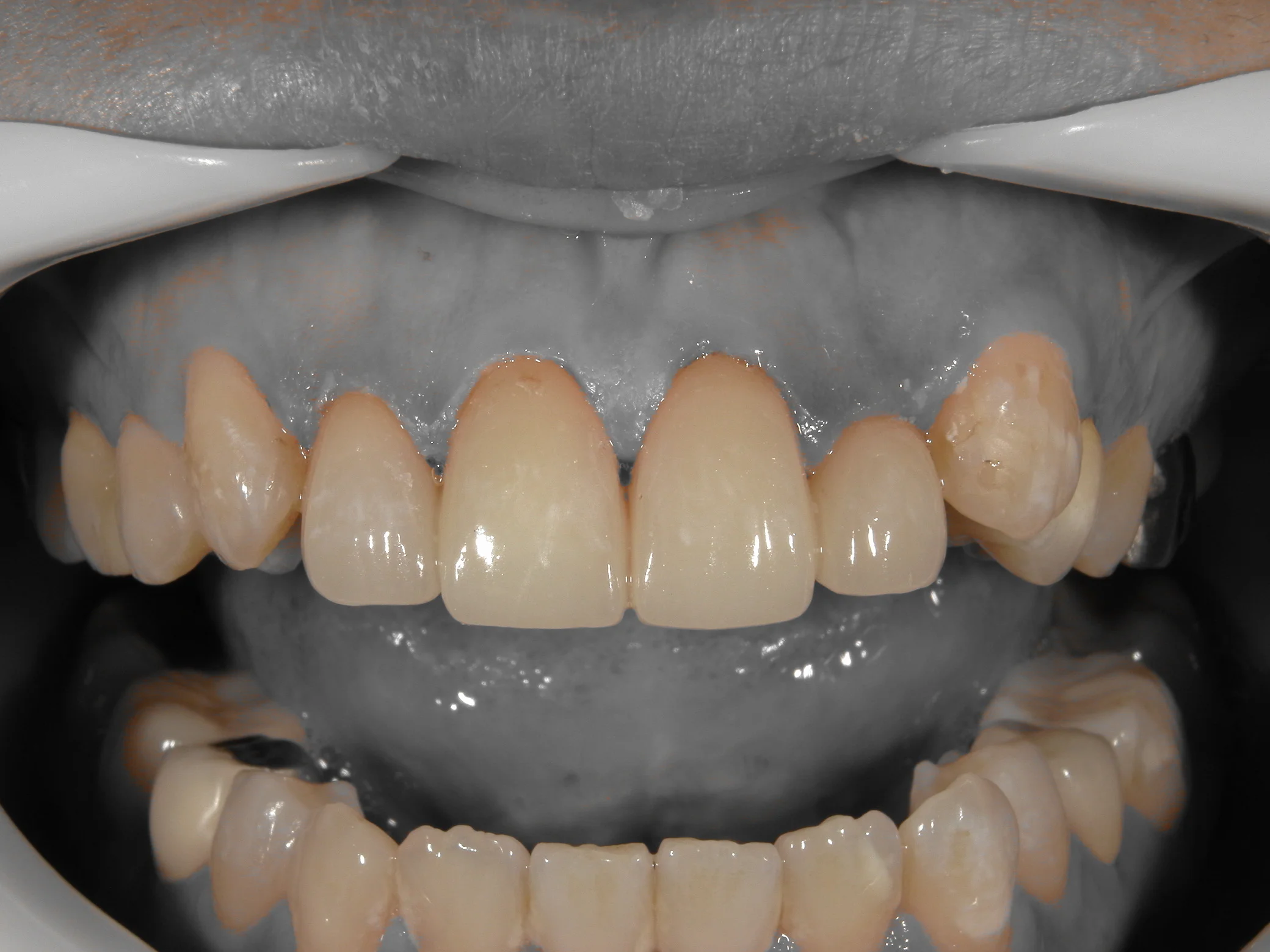 前歯セラミッククラウン|坂寄歯科医院(取手市藤代) - 画像3