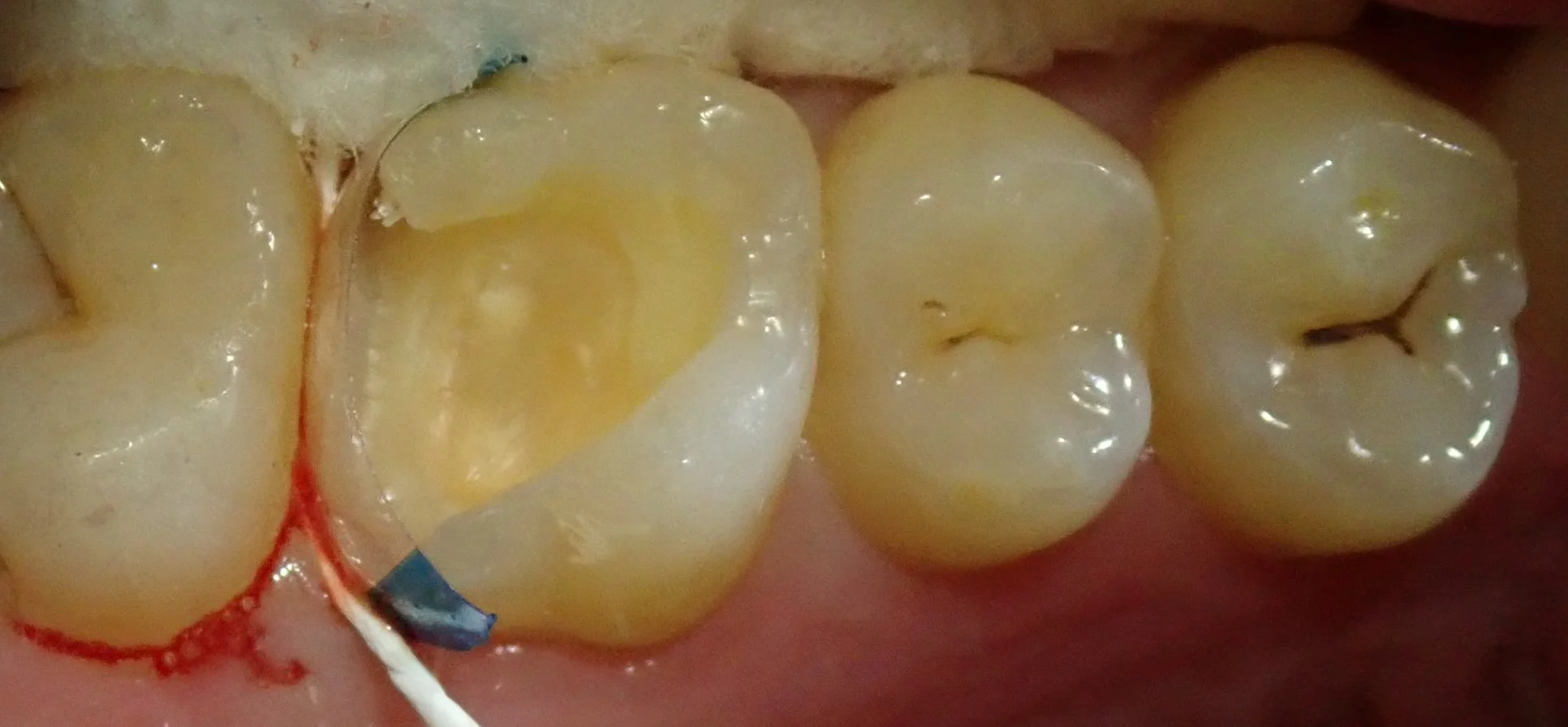 テフロンテープを用いたレジン治療｜坂寄歯科医院（取手市藤代） - 画像4