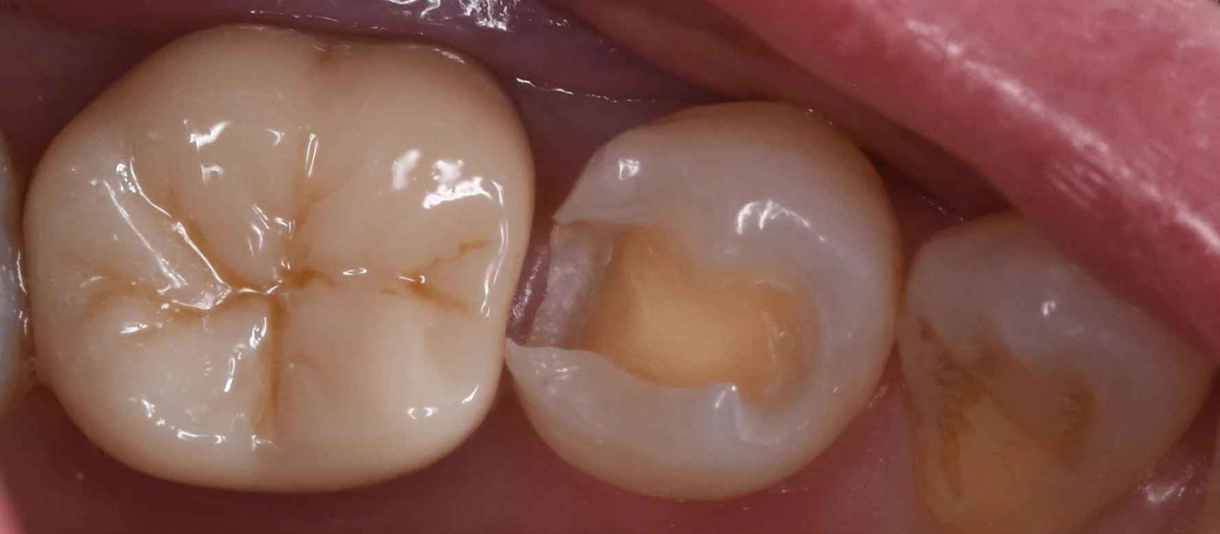 セラミックの被せ物|坂寄歯科医院(取手市藤代) - 画像6