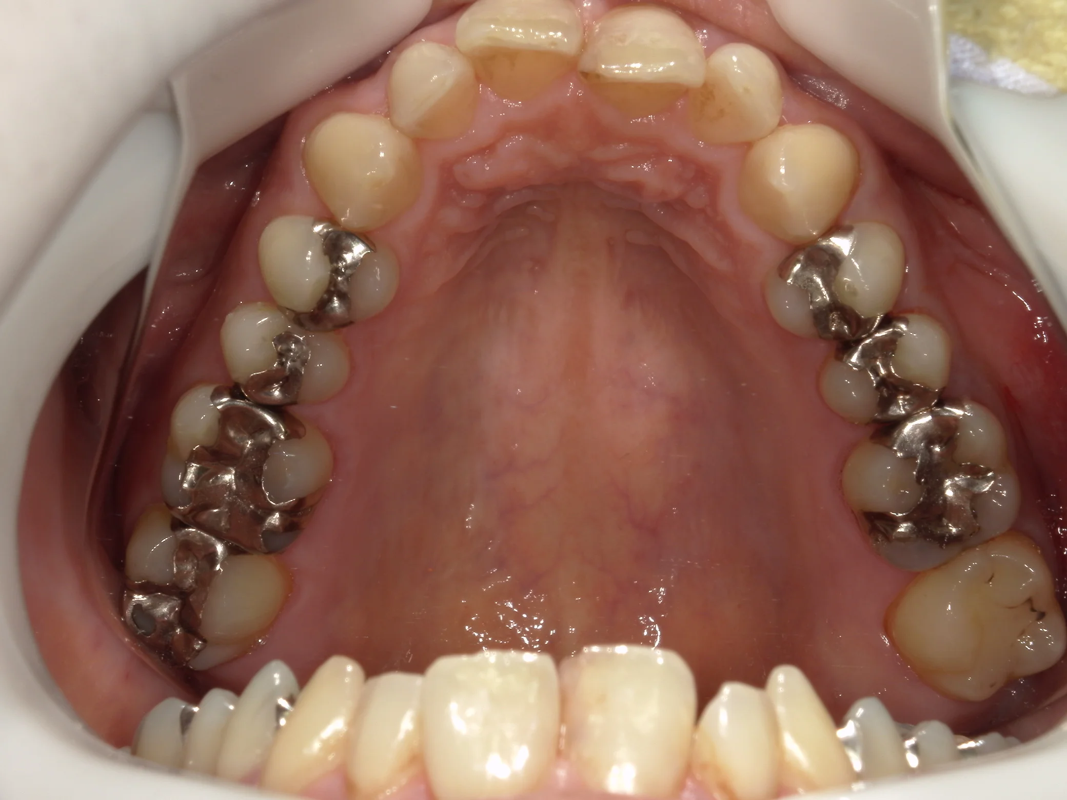 全体的に金属を白くしたいという方の治療｜坂寄歯科医院（取手市藤代） - 画像5