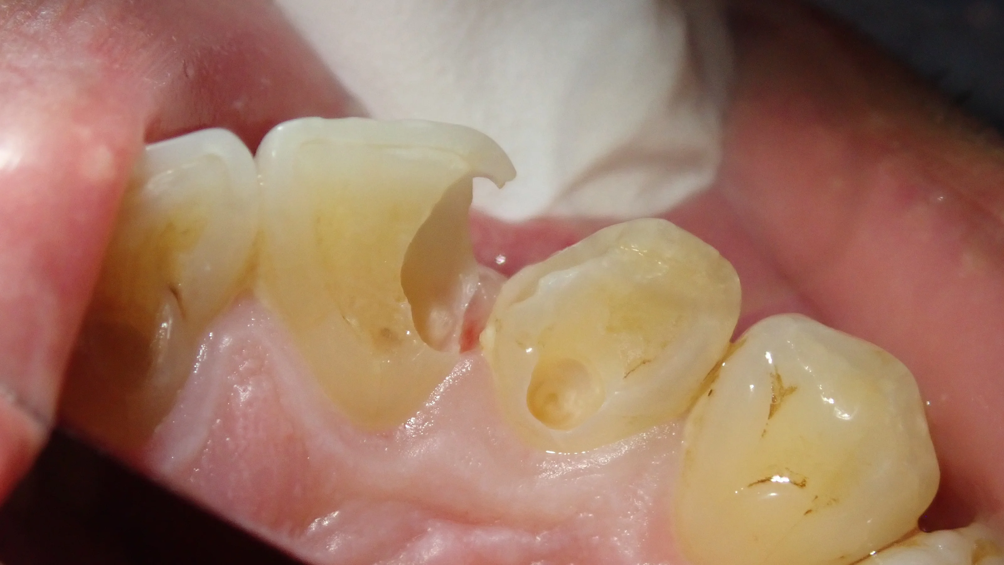 前歯の白い詰め物｜坂寄歯科医院（取手市藤代） - 画像6