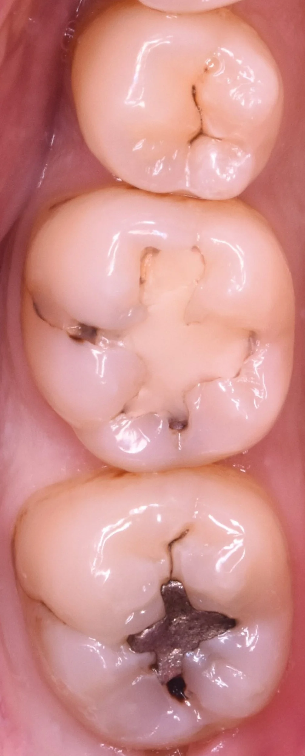 奥歯2本の治療を1日で。|坂寄歯科医院(取手市藤代)