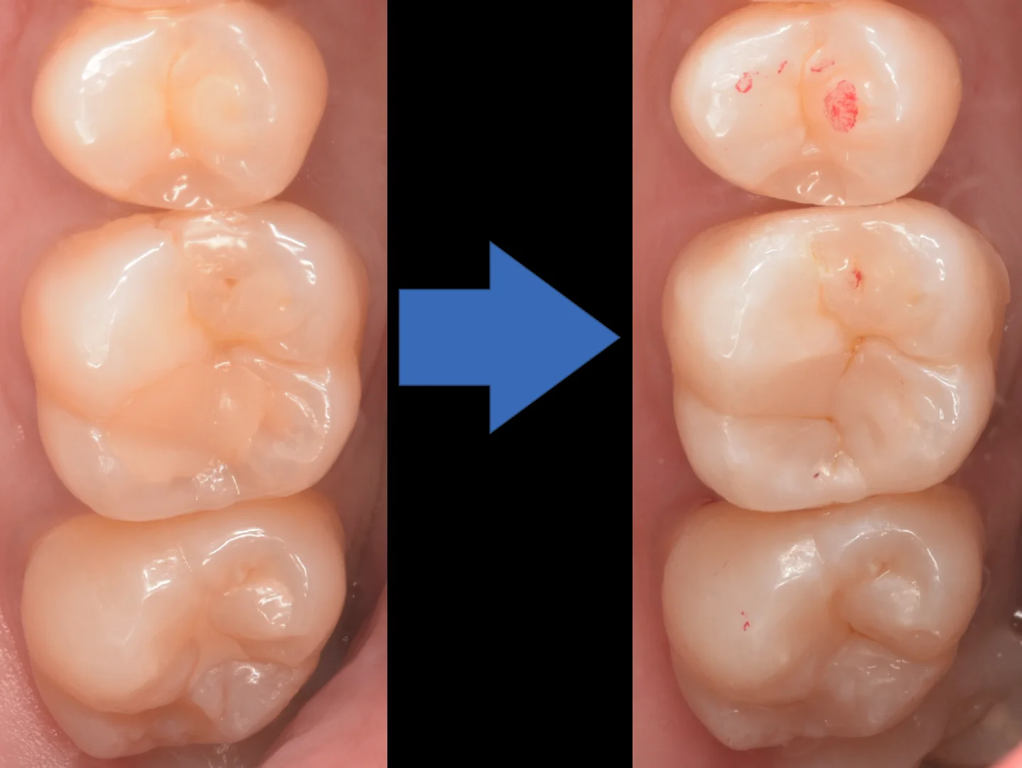 印西市からお越しの方。｜坂寄歯科医院（取手市藤代） - 画像5