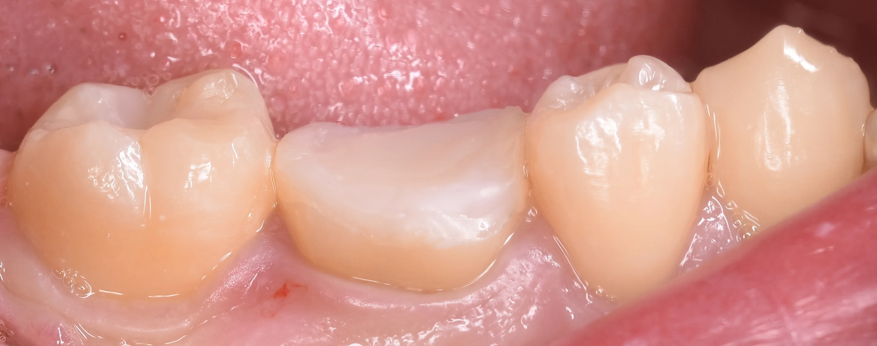 セラミックの被せ物|坂寄歯科医院(取手市藤代)