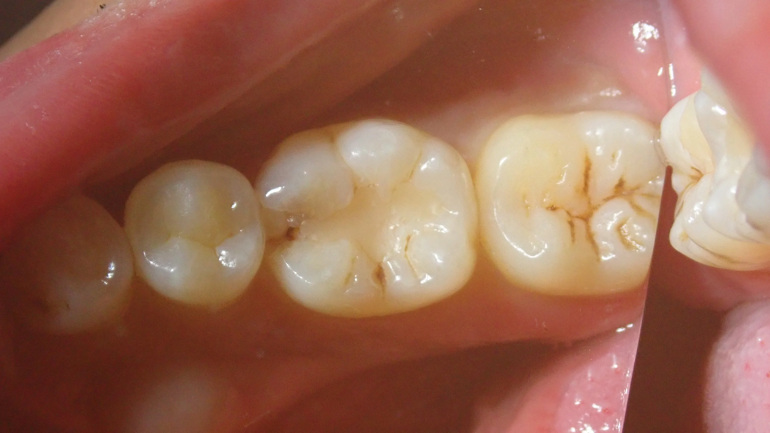 ダイレクトボンディング⑧|坂寄歯科医院(取手市藤代)