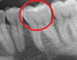 ダイレクトボンディング⑧|坂寄歯科医院(取手市藤代) - 画像2
