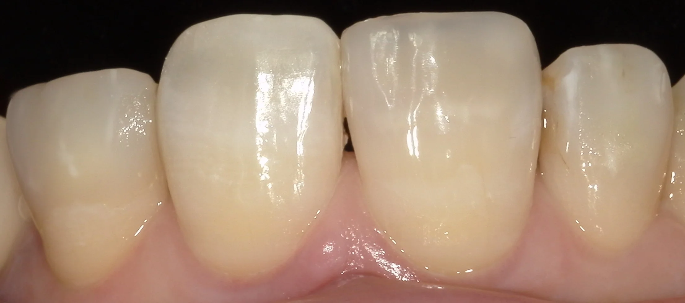 前歯が折れてしまったケース。｜坂寄歯科医院（取手市藤代） - 画像4