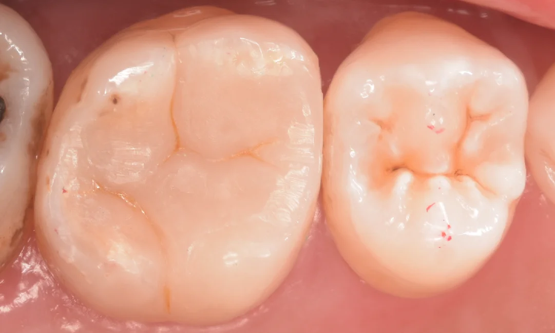 歯科医師の方を治療。｜坂寄歯科医院（取手市藤代） - 画像5