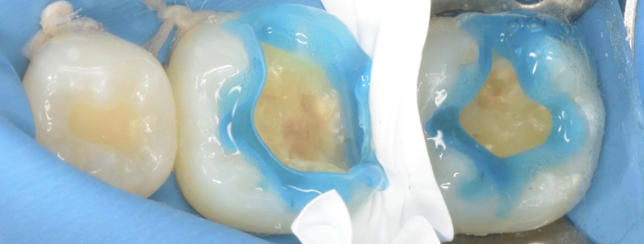 歯科医師の方のCAD/CAMインレーを治療。|坂寄歯科医院(取手市藤代) - 画像4