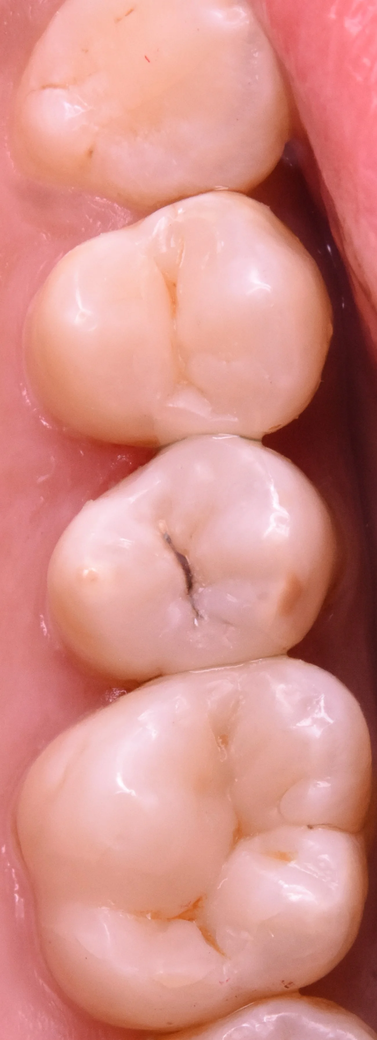 奥歯3本を纏めて一気に治療。|坂寄歯科医院(取手市藤代) - 画像4