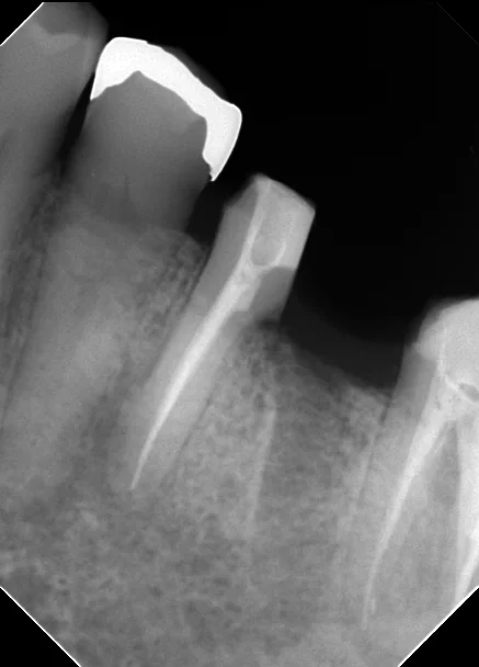 その抜歯ちょっと待って！｜坂寄歯科医院（取手市藤代） - 画像3
