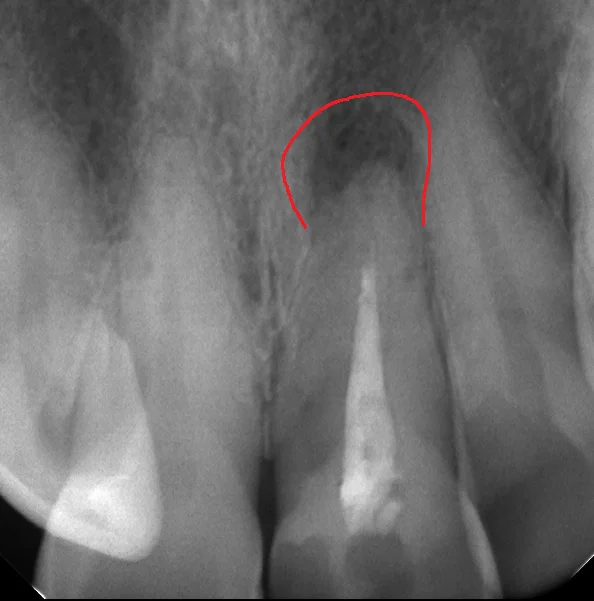 前歯の根管治療|坂寄歯科医院(取手市藤代)
