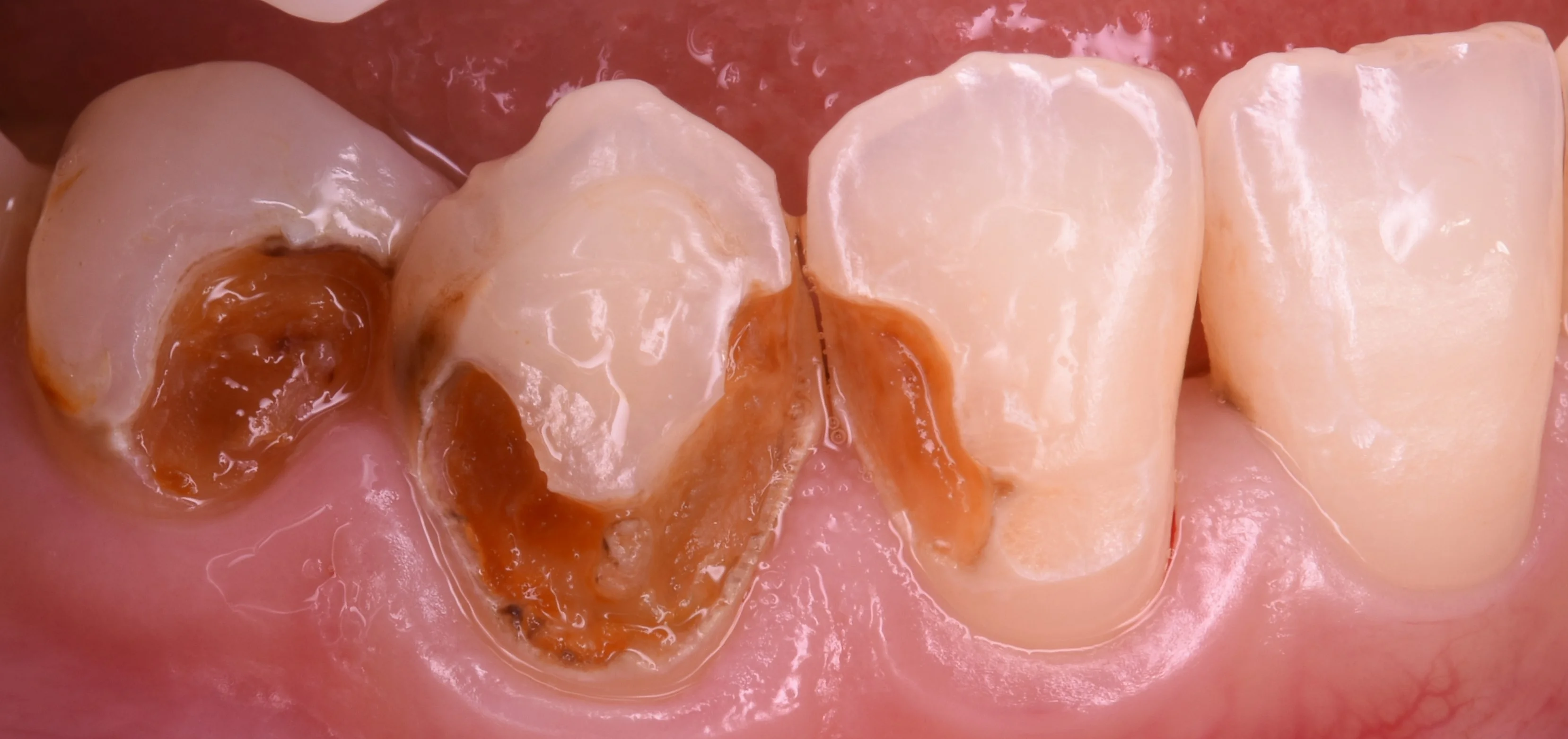 前歯を纏めて白く。|坂寄歯科医院(取手市藤代)