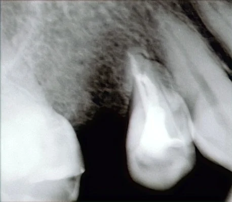 ダイレクトボンディング術後4年での補修修復|坂寄歯科医院(取手市藤代) - 画像3