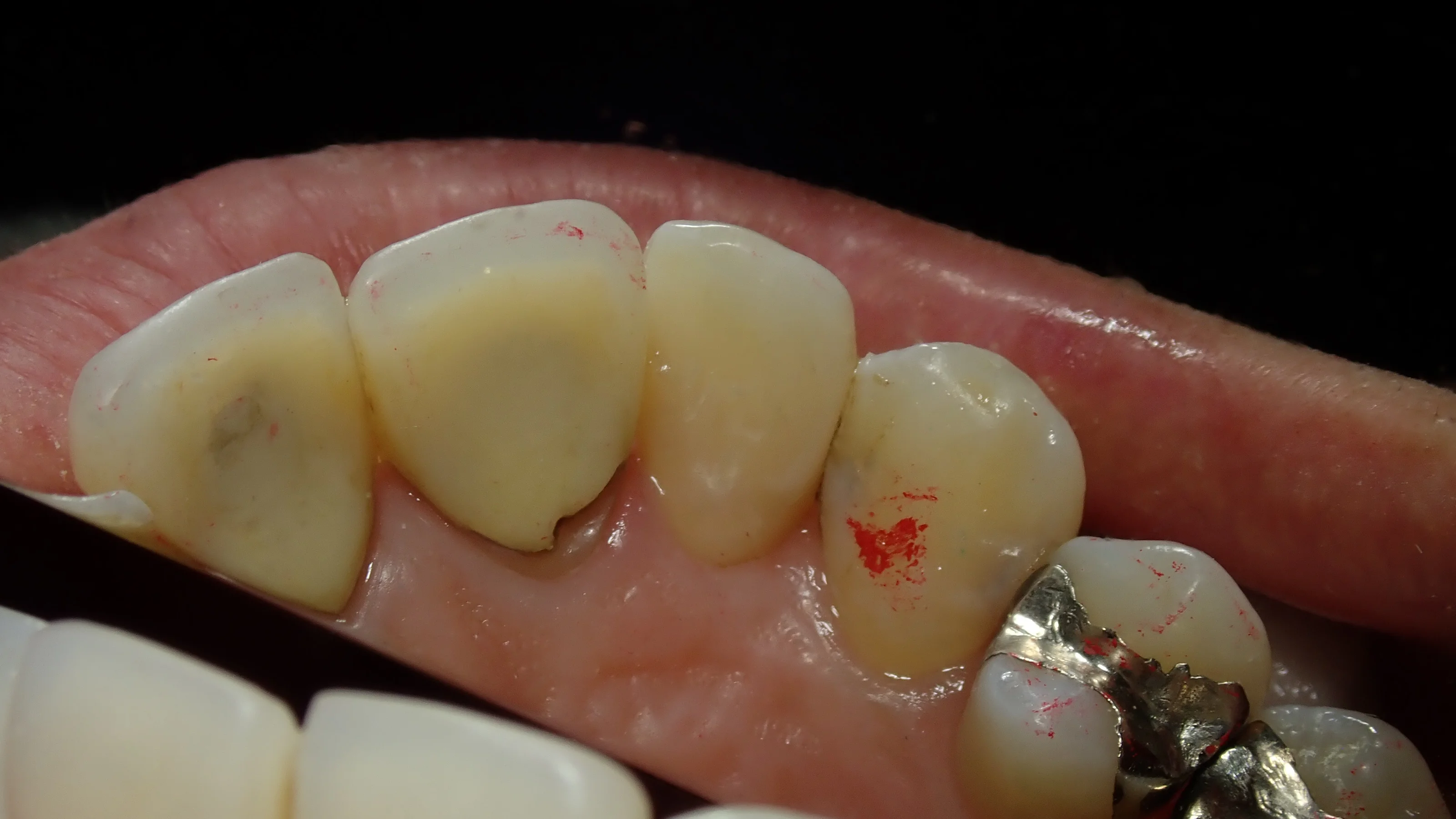 前歯ダイレクトボンディング｜坂寄歯科医院（取手市藤代） - 画像4