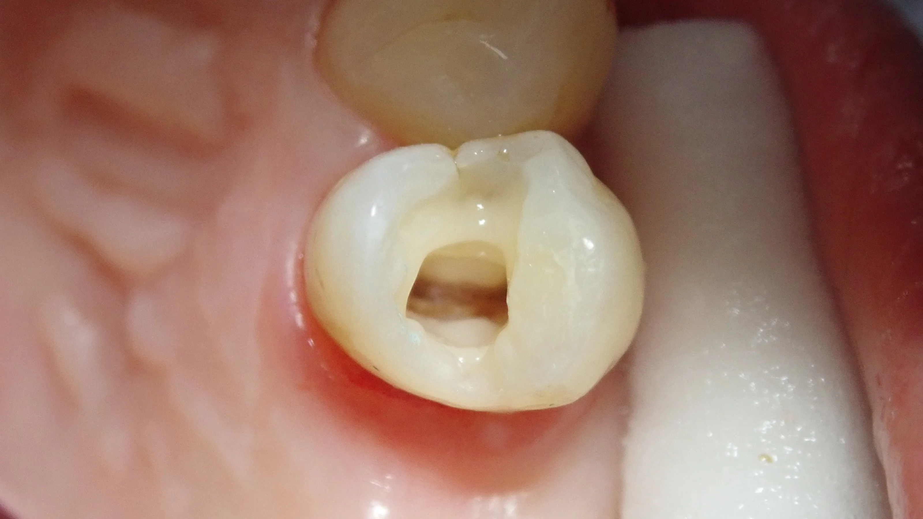 ダイレクトボンディング④|坂寄歯科医院(取手市藤代) - 画像4