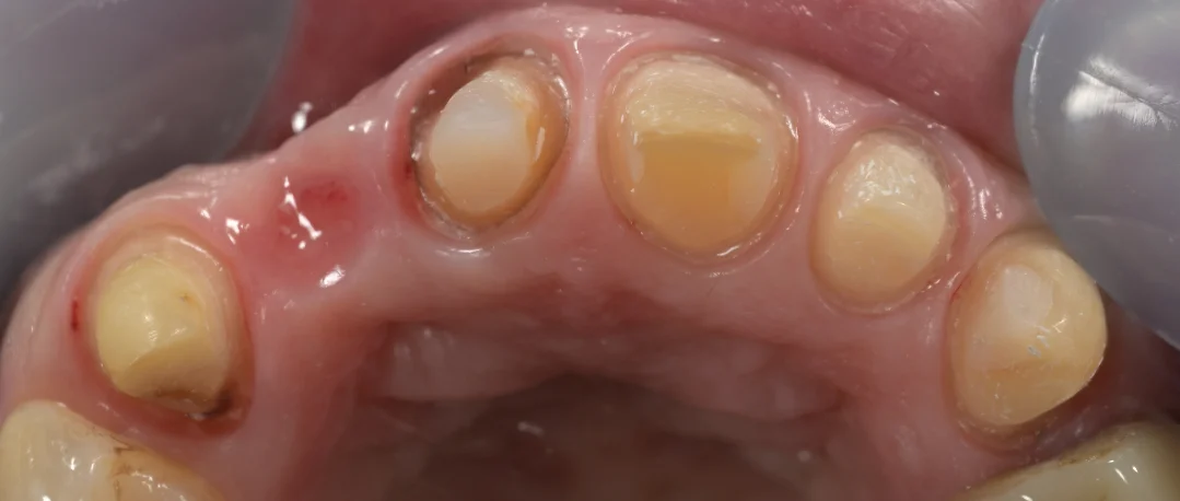 審美治療：セラミック｜坂寄歯科医院（取手市藤代） - 画像4