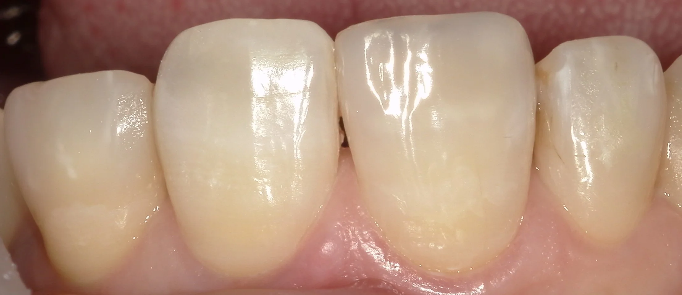 前歯が折れてしまったケース。｜坂寄歯科医院（取手市藤代） - 画像3