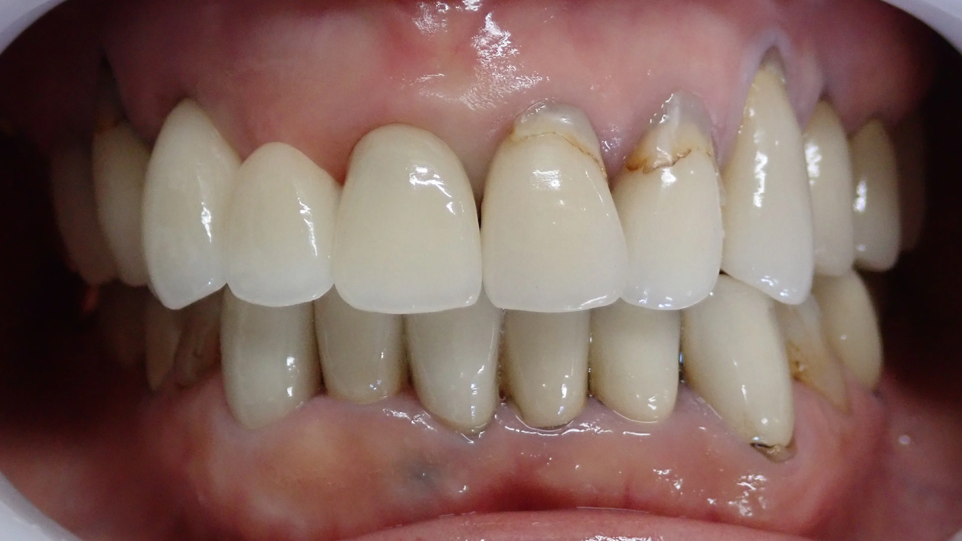 オールセラミックスブリッジ|坂寄歯科医院(取手市藤代) - 画像2