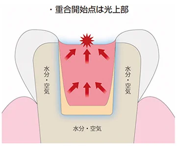【歯科医師向け】重合収縮のコントロールについて【1級窩洞編】｜坂寄歯科医院（取手市藤代）