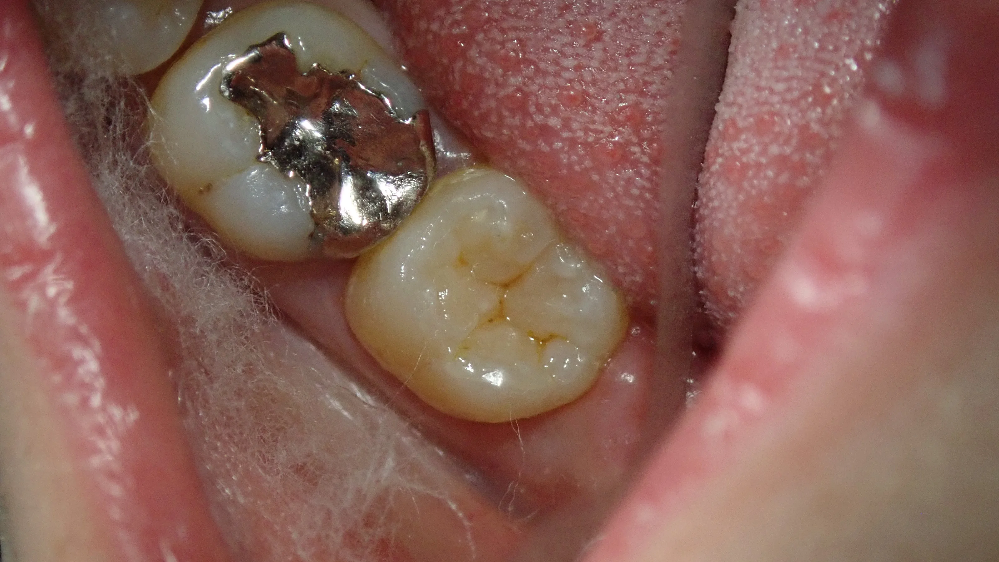 奥2本のダイレクトボンディング|坂寄歯科医院(取手市藤代) - 画像3