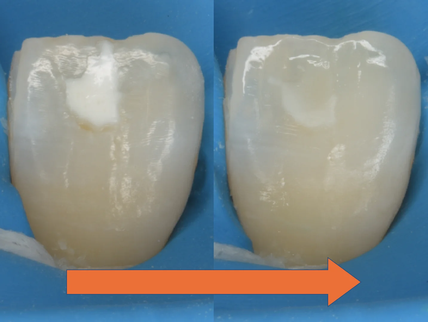 ICON治療にて改善しきらなかったケース。｜坂寄歯科医院（取手市藤代） - 画像2