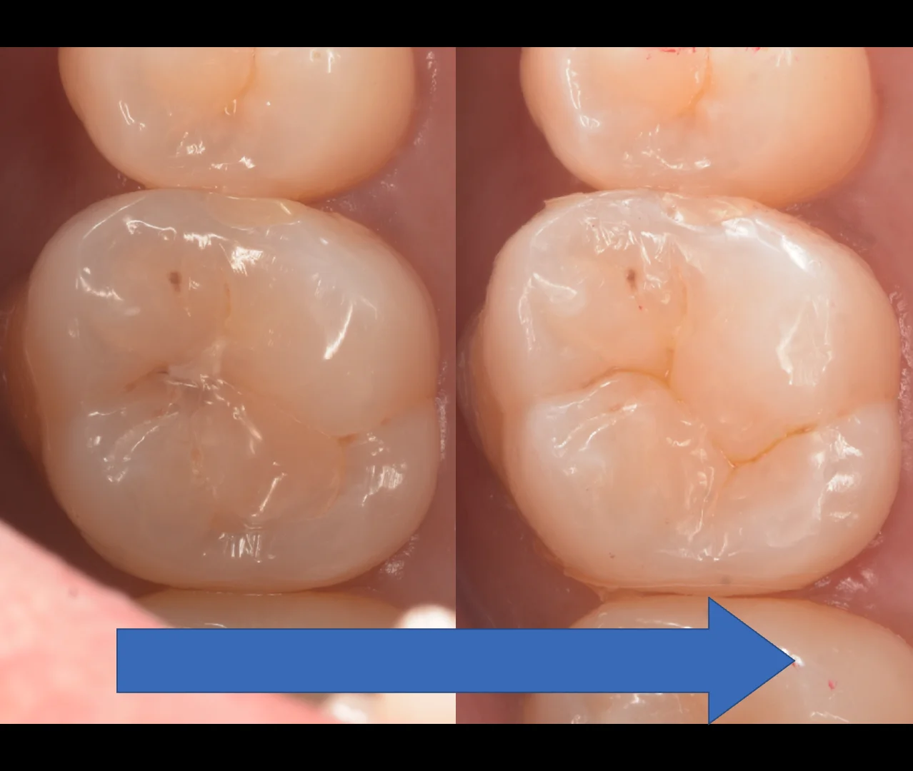 印西からお越しの方。|坂寄歯科医院(取手市藤代) - 画像6