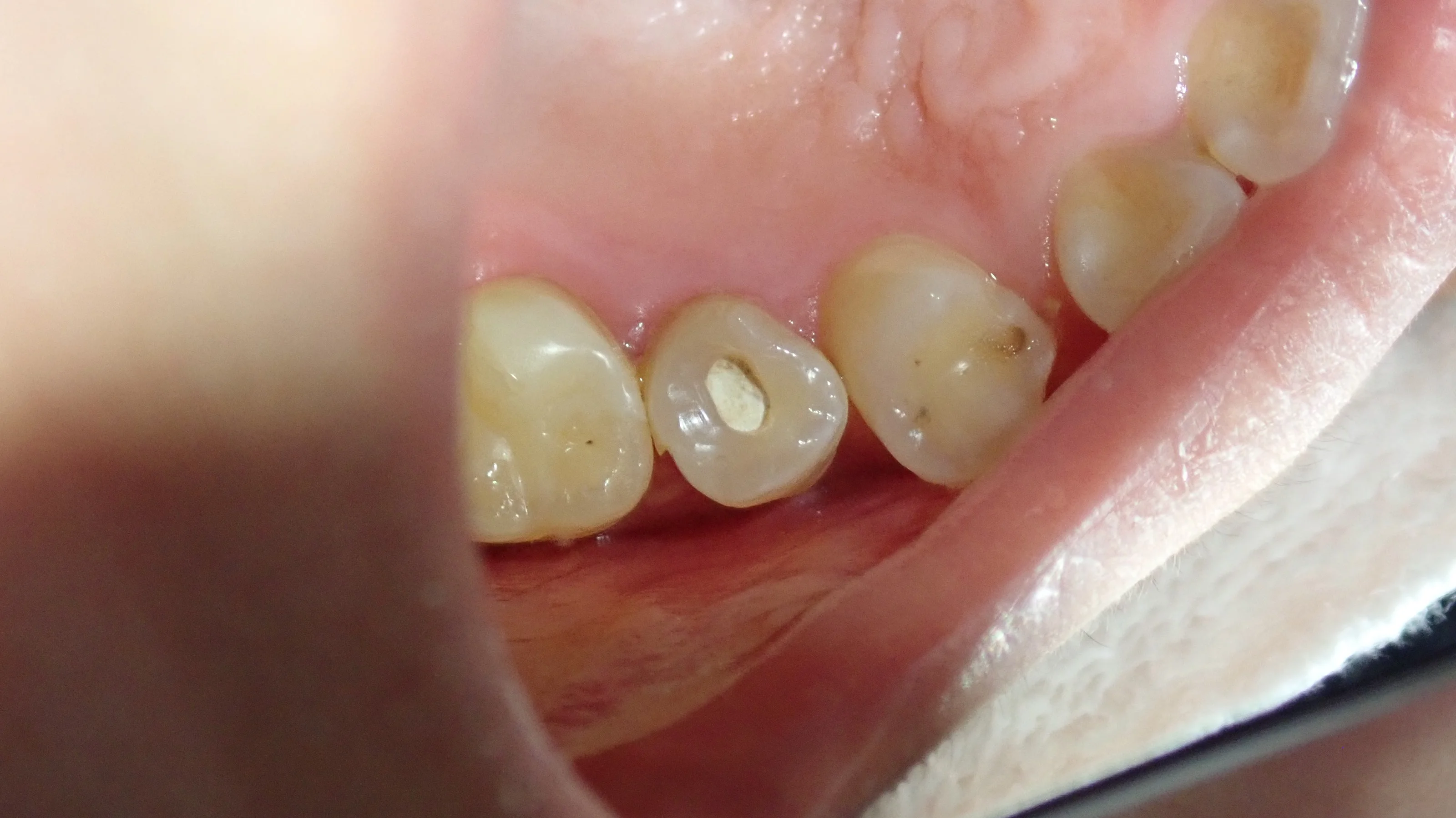 上顎小臼歯ダイレクトボンディング|坂寄歯科医院(取手市藤代)