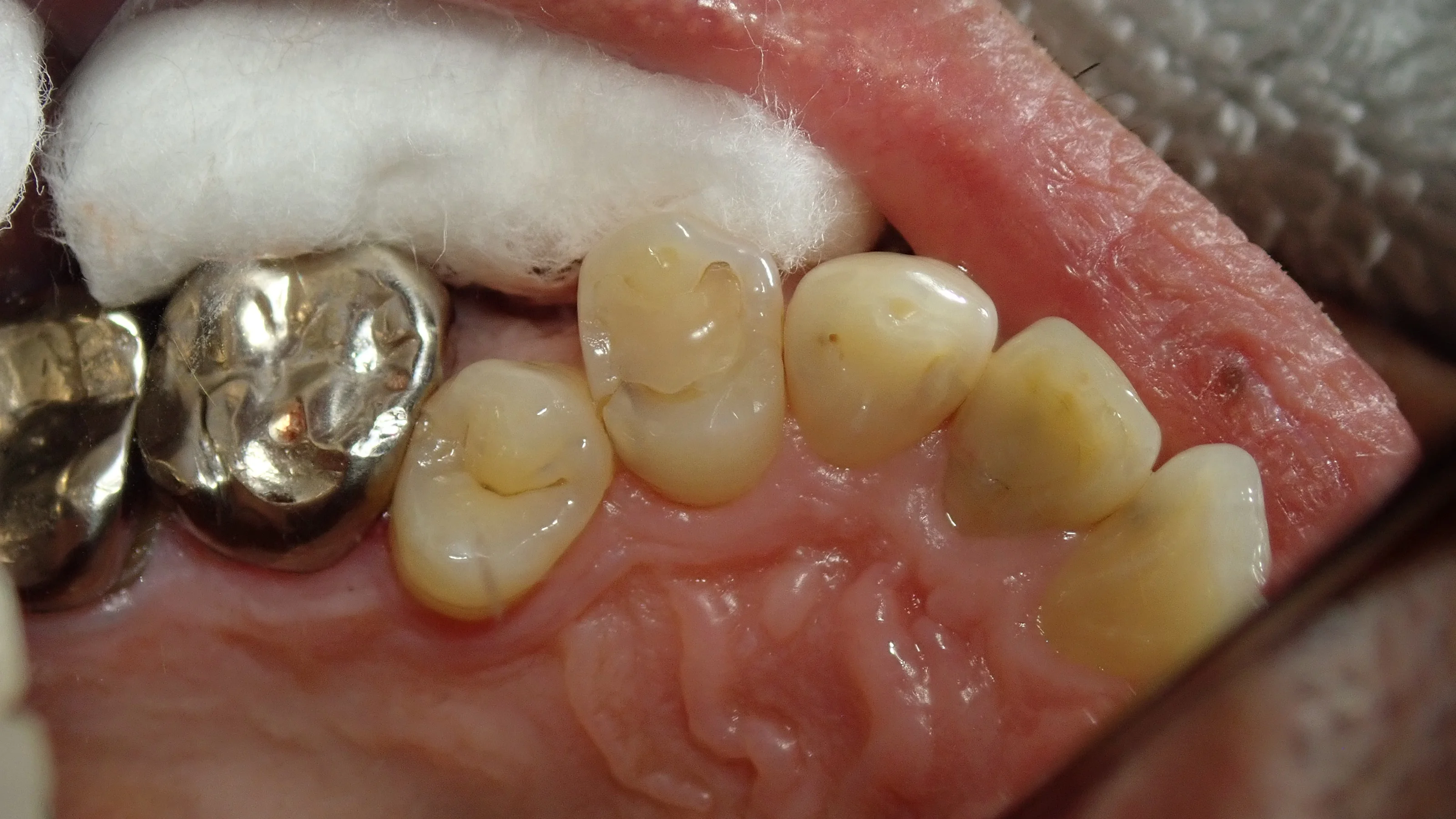 左上3本まとめてダイレクトボンディング｜坂寄歯科医院（取手市藤代）