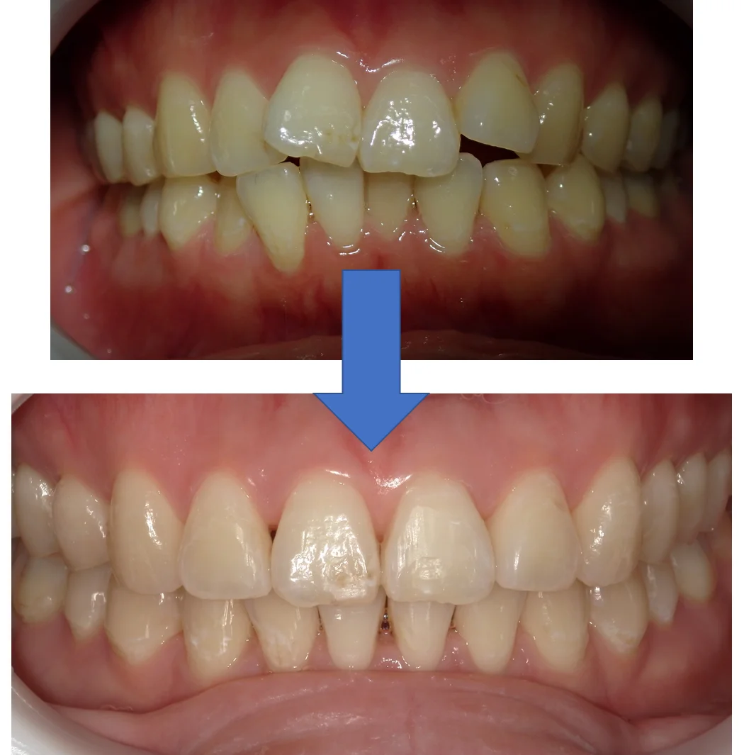 インビザライン矯正の術前術後|坂寄歯科医院(取手市藤代) - 画像2