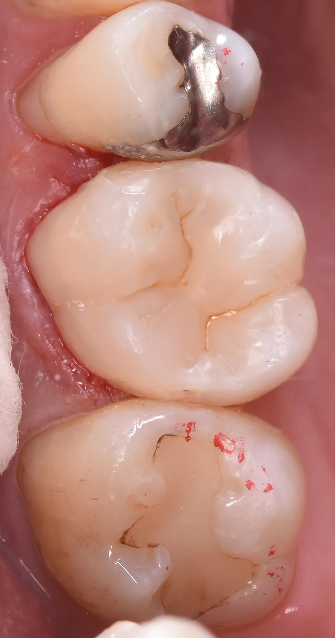 金属を白い詰め物に。|坂寄歯科医院(取手市藤代) - 画像3