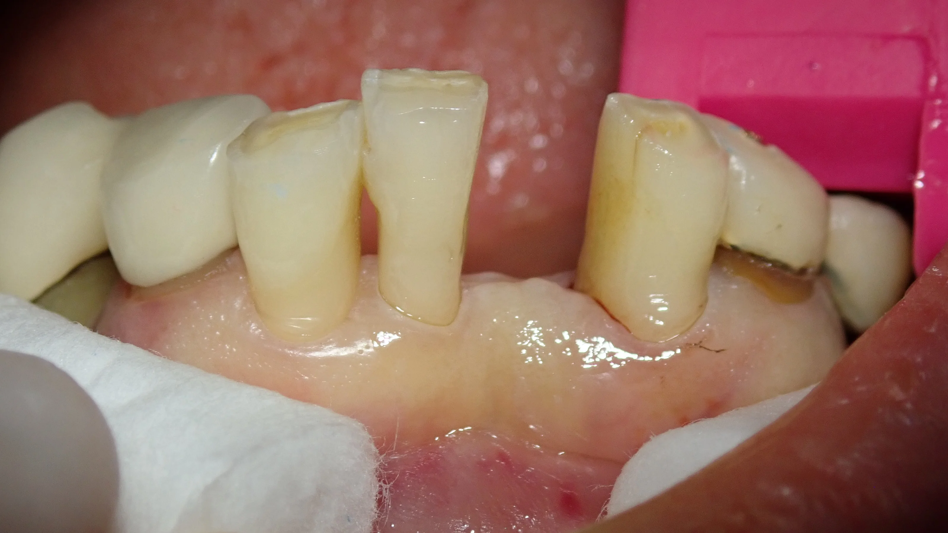 接着性ブリッジ|坂寄歯科医院(取手市藤代) - 画像2