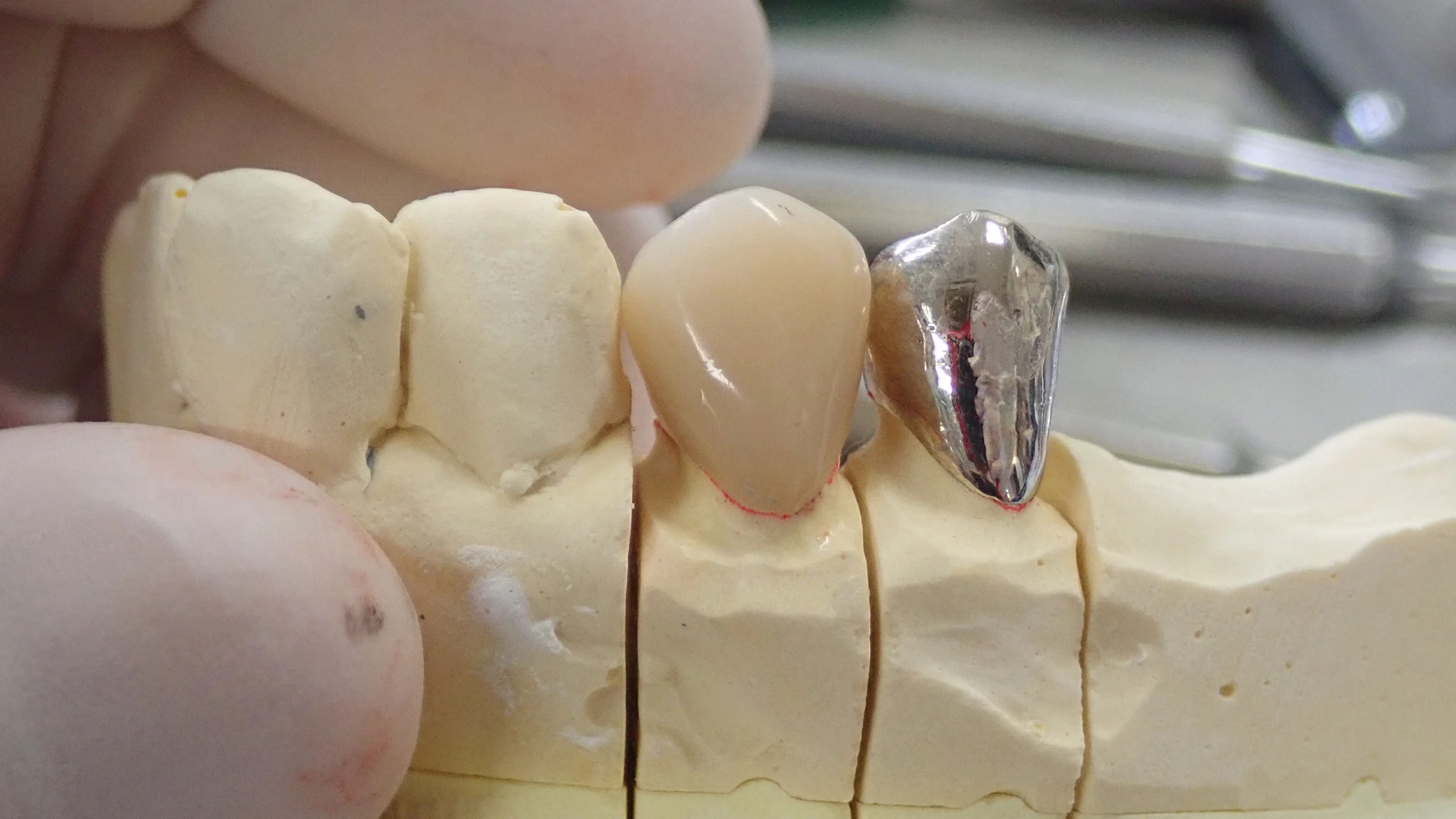 硬質レジンジャケット冠|坂寄歯科医院(取手市藤代) - 画像4