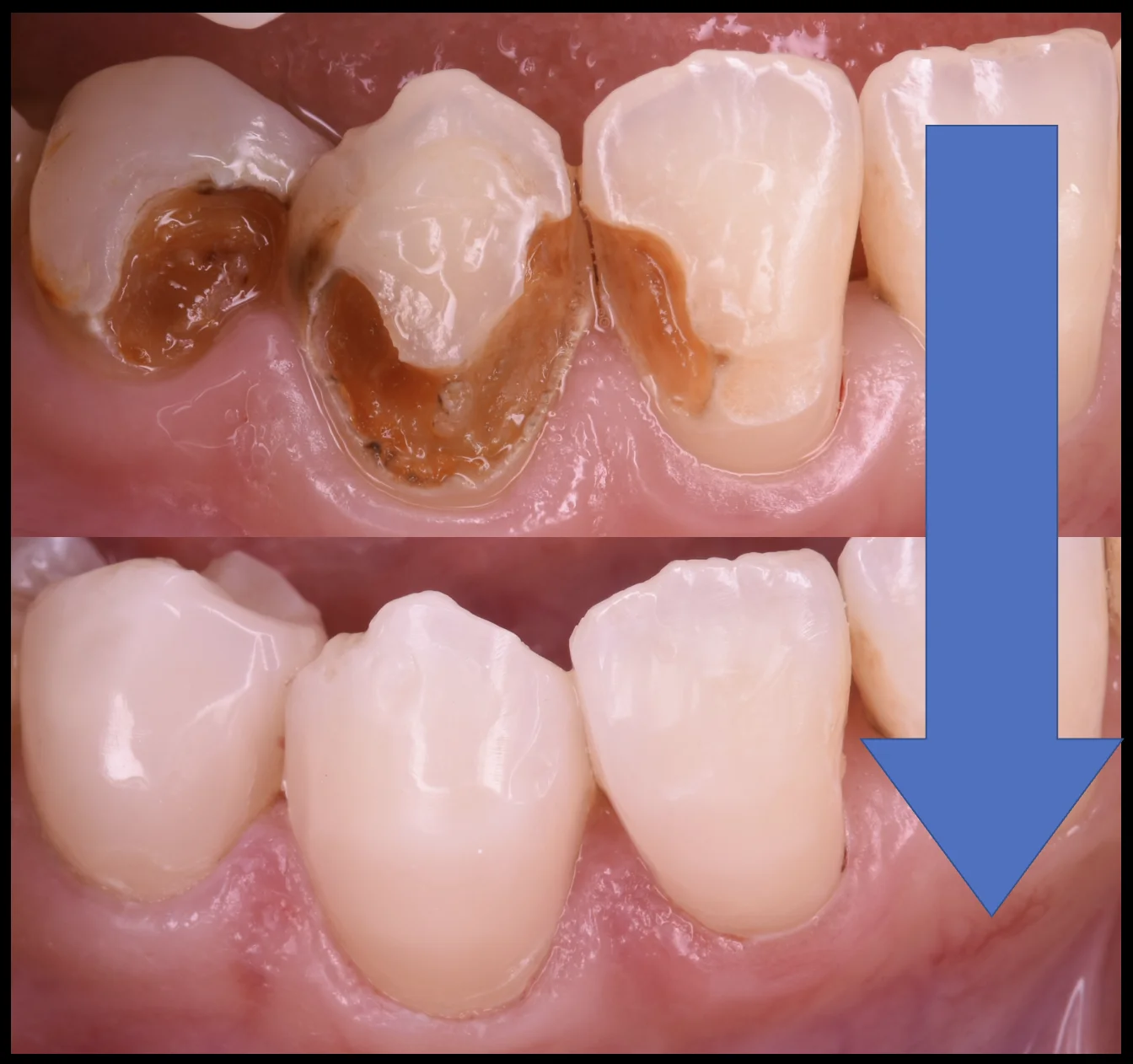 前歯を纏めて白く。|坂寄歯科医院(取手市藤代) - 画像4