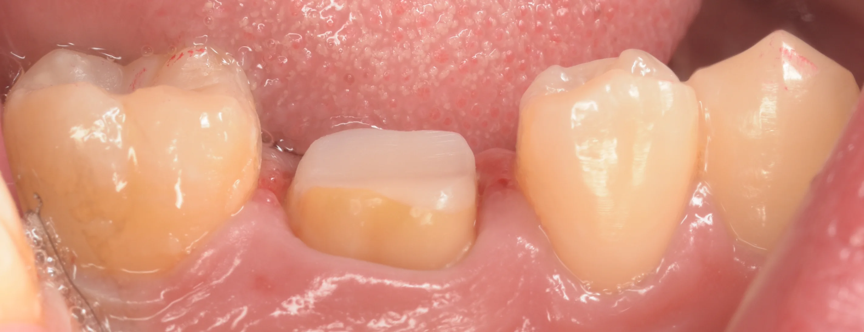 セラミックの被せ物|坂寄歯科医院(取手市藤代) - 画像4