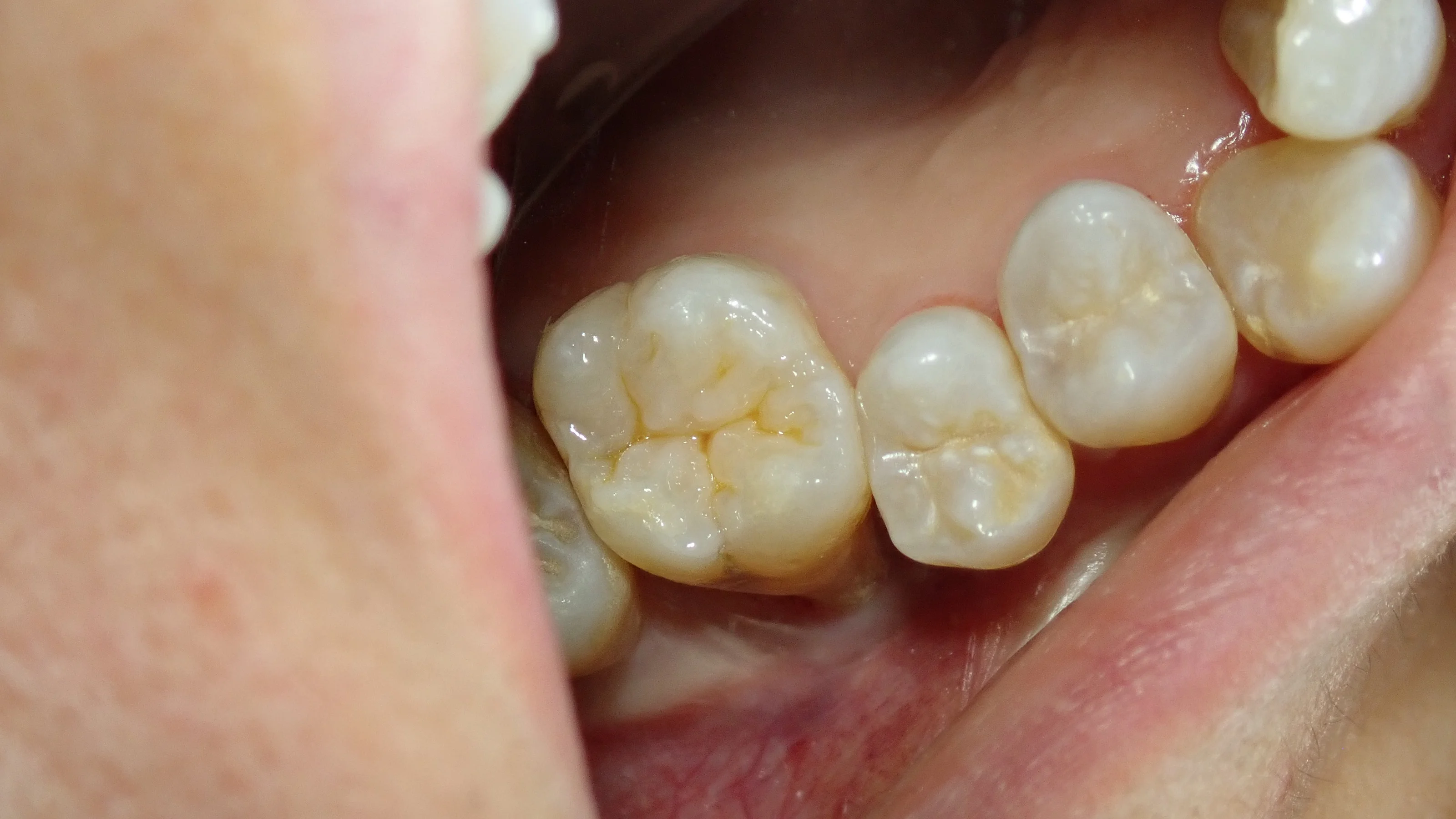 右上6ダイレクトボンディング|坂寄歯科医院(取手市藤代) - 画像4