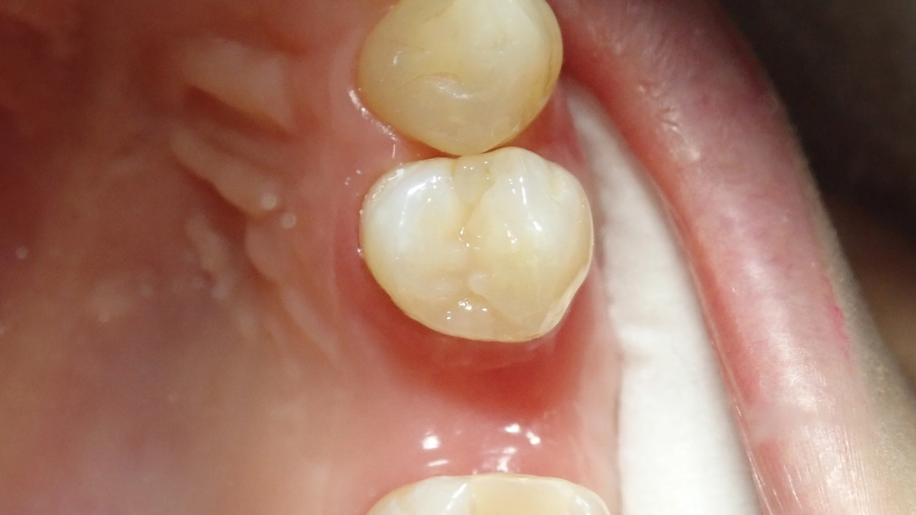 ダイレクトボンディング④|坂寄歯科医院(取手市藤代) - 画像7