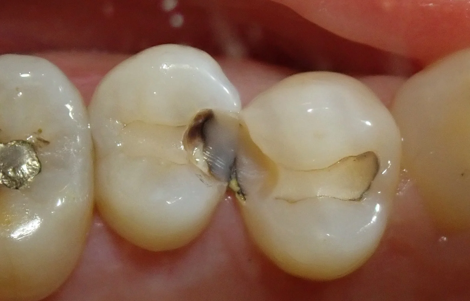 保険の白い詰め物|坂寄歯科医院(取手市藤代) - 画像2