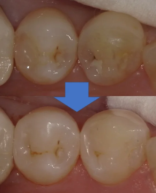 右下奥歯を纏めて治療。遠方からの通院。｜坂寄歯科医院（取手市藤代） - 画像5