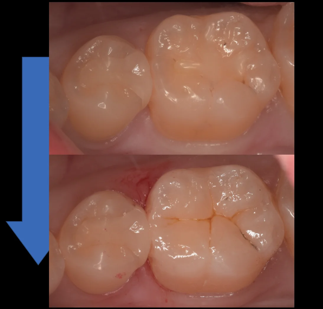 歯科医師の歯を1日で本物の歯のように。|坂寄歯科医院(取手市藤代) - 画像4