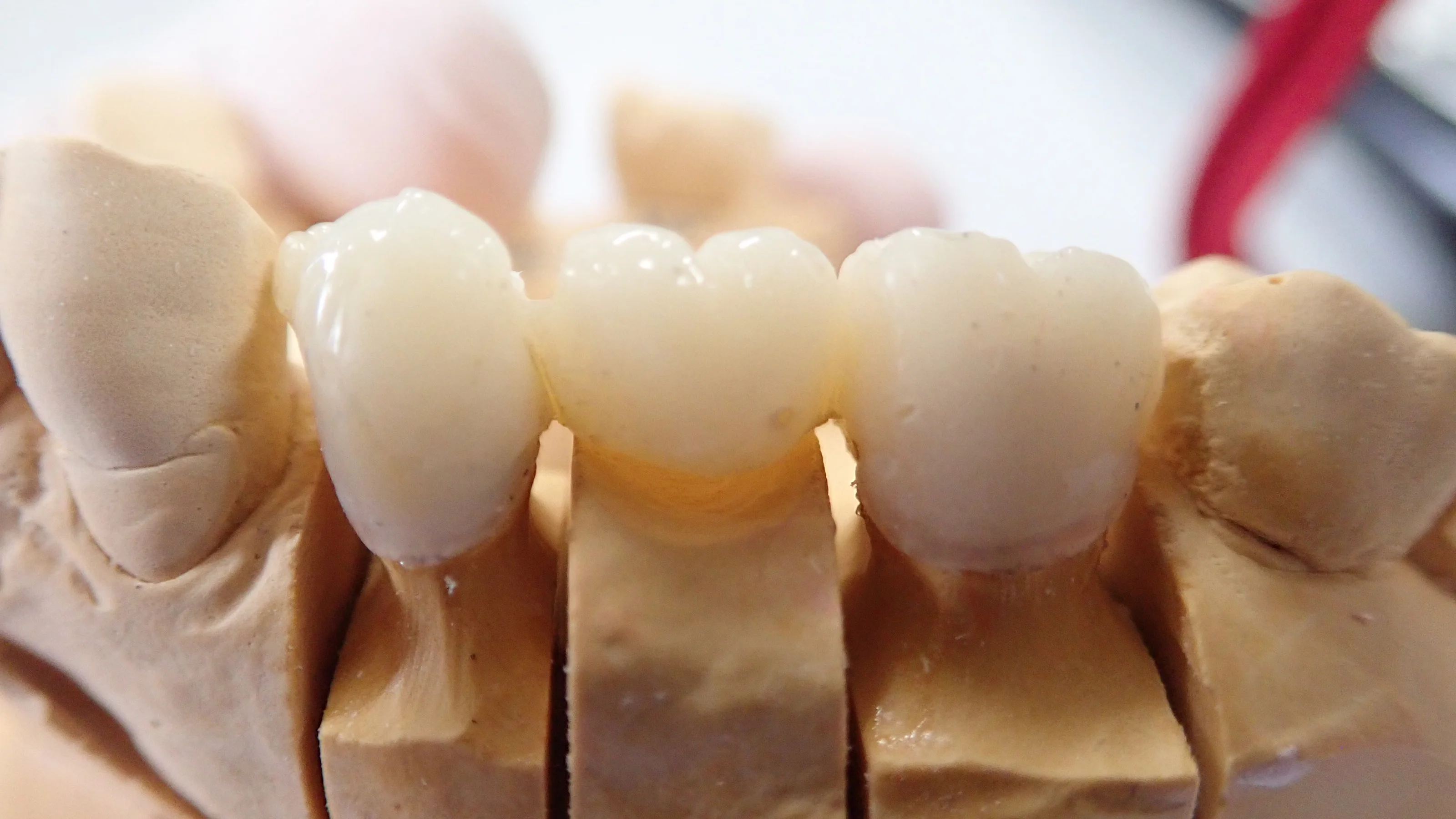 仮歯へのこだわり|坂寄歯科医院(取手市藤代) - 画像2