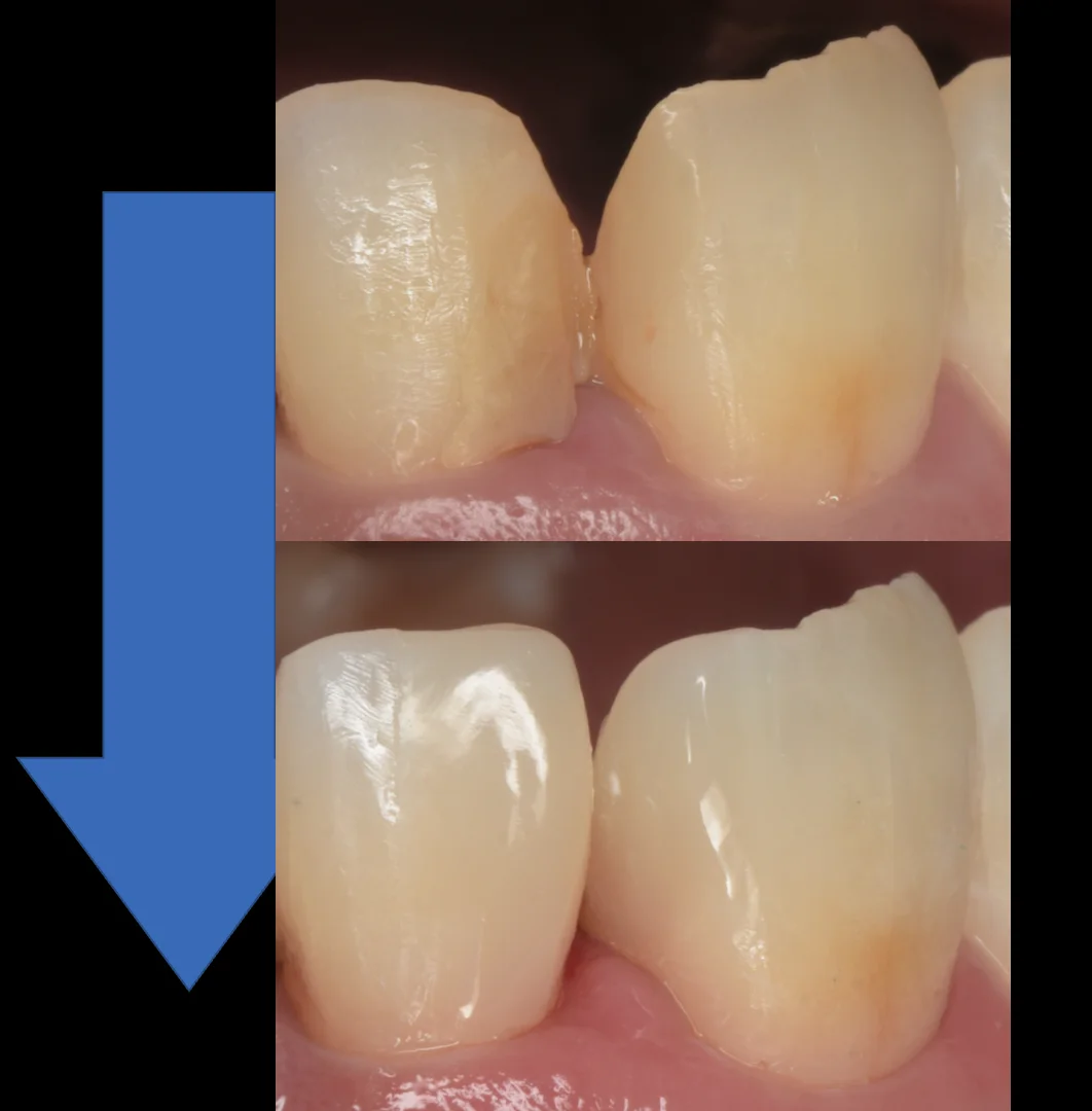 不適合なレジンを再治療。|坂寄歯科医院(取手市藤代) - 画像4