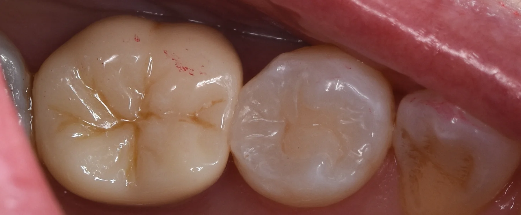 セラミックの被せ物|坂寄歯科医院(取手市藤代) - 画像7