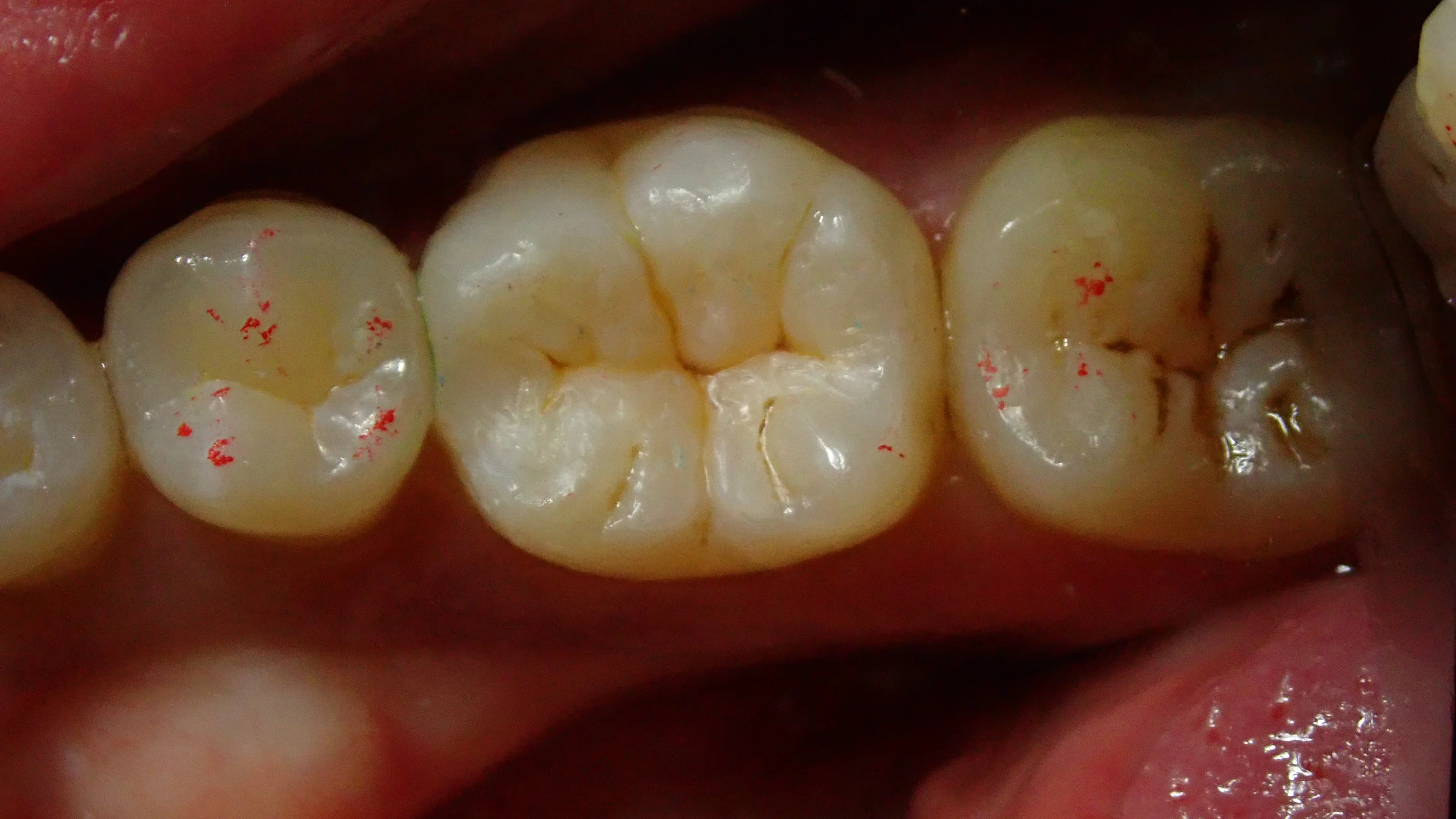 ダイレクトボンディング⑧|坂寄歯科医院(取手市藤代) - 画像5