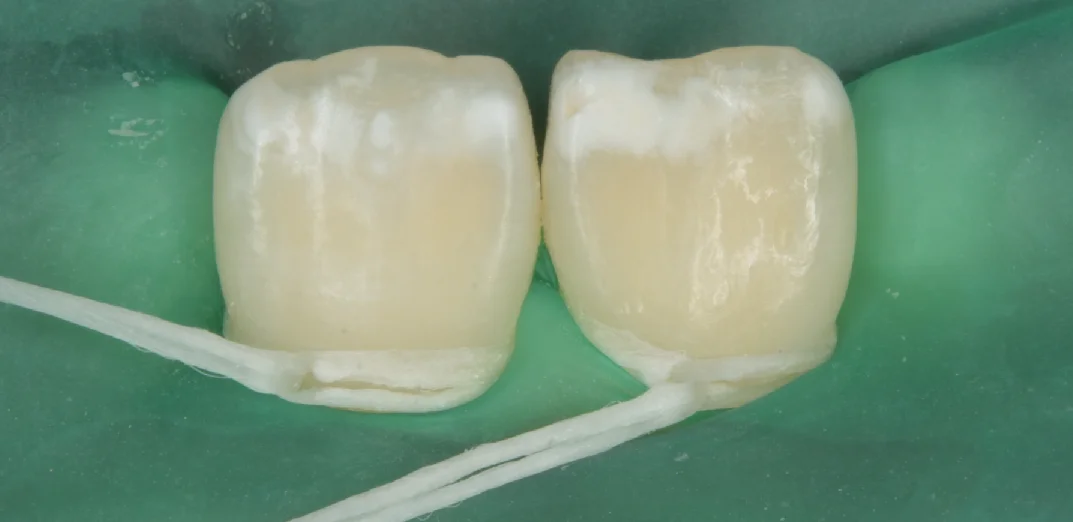 遠方よりICON治療を求めて・・・｜坂寄歯科医院（取手市藤代） - 画像2