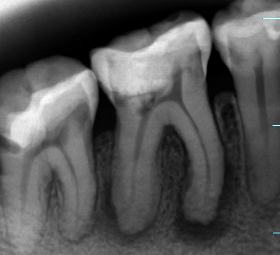 神経の治療②｜坂寄歯科医院（取手市藤代）