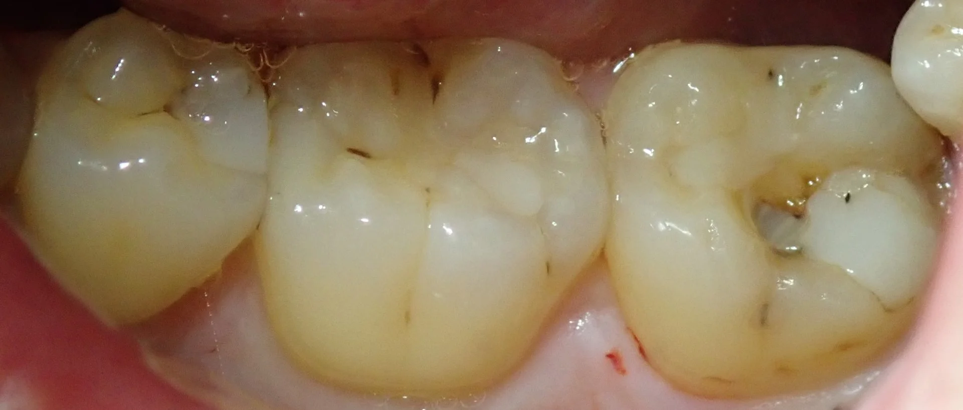 左下奥2本の白い詰め物|坂寄歯科医院(取手市藤代)