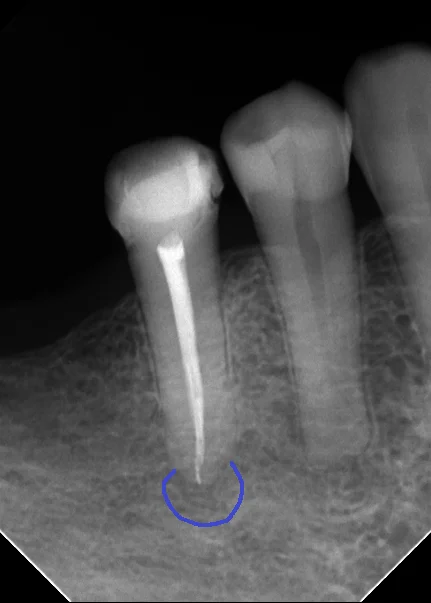 レジンでは無理ですって！｜坂寄歯科医院（取手市藤代） - 画像2