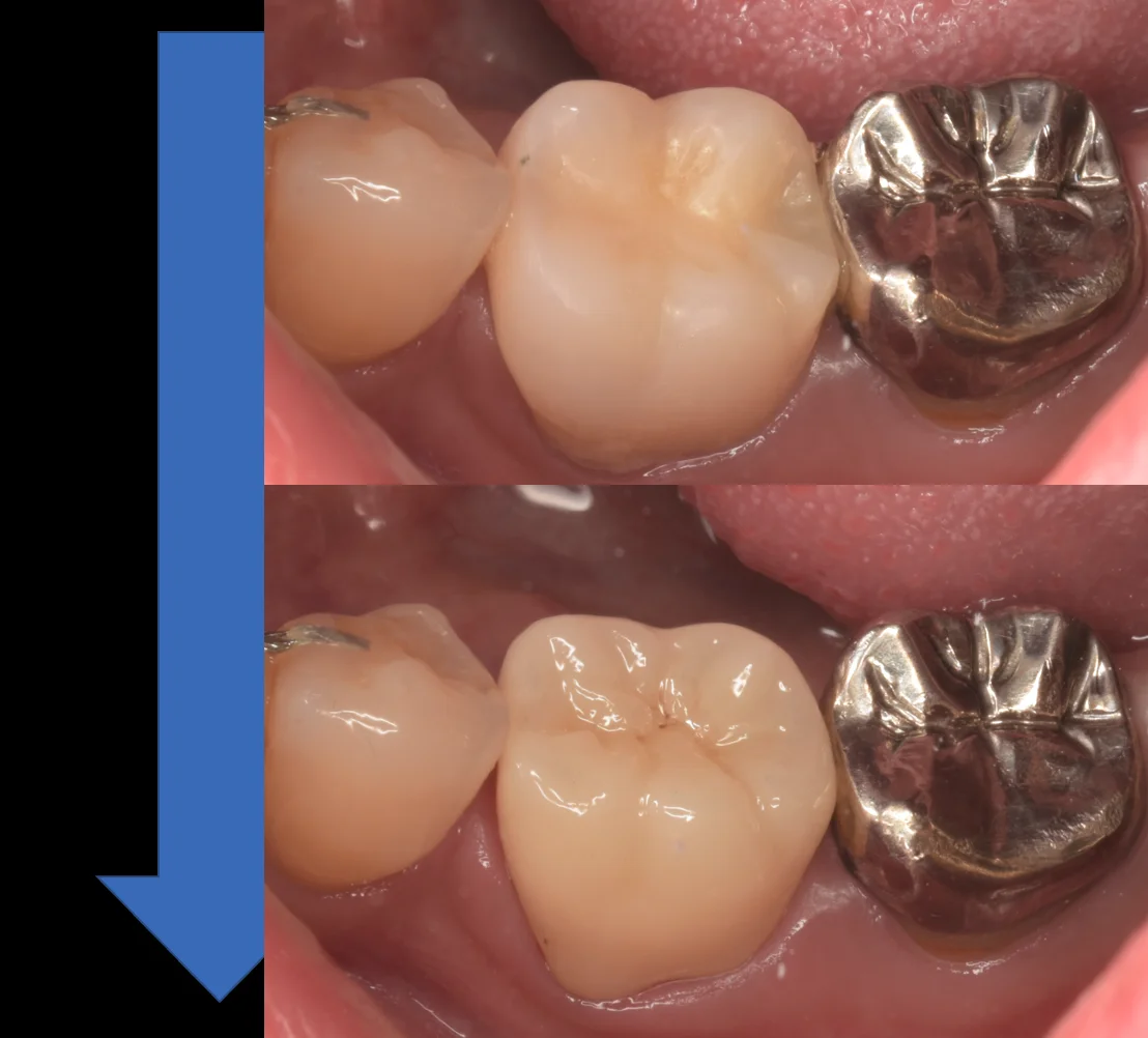 神経の治療後をセラミックで。|坂寄歯科医院(取手市藤代) - 画像4